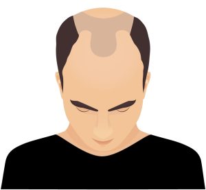 MaleBalding